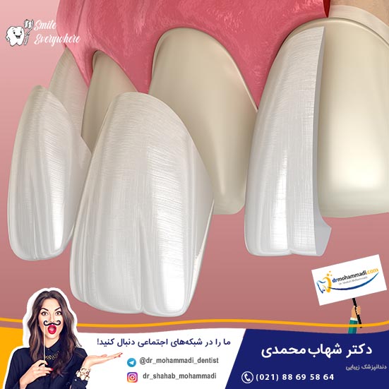 همه چیز درباره لمینت بدون تراش دندان و قیمت آن- کلینیک دندانپزشکی دکتر شهاب محمدی